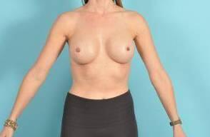 Breast Augmentation Before & After Image Patient 28911