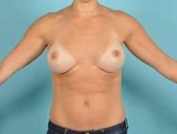 Breast Augmentation Before & After Image Patient 28913