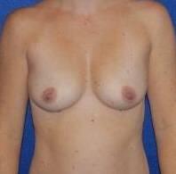 Breast Augmentation Before & After Image Patient 28918