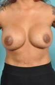 Breast Implant Correction Before & After Image Patient 27005