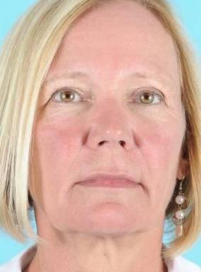 Facelift Before & After Image Patient 31505