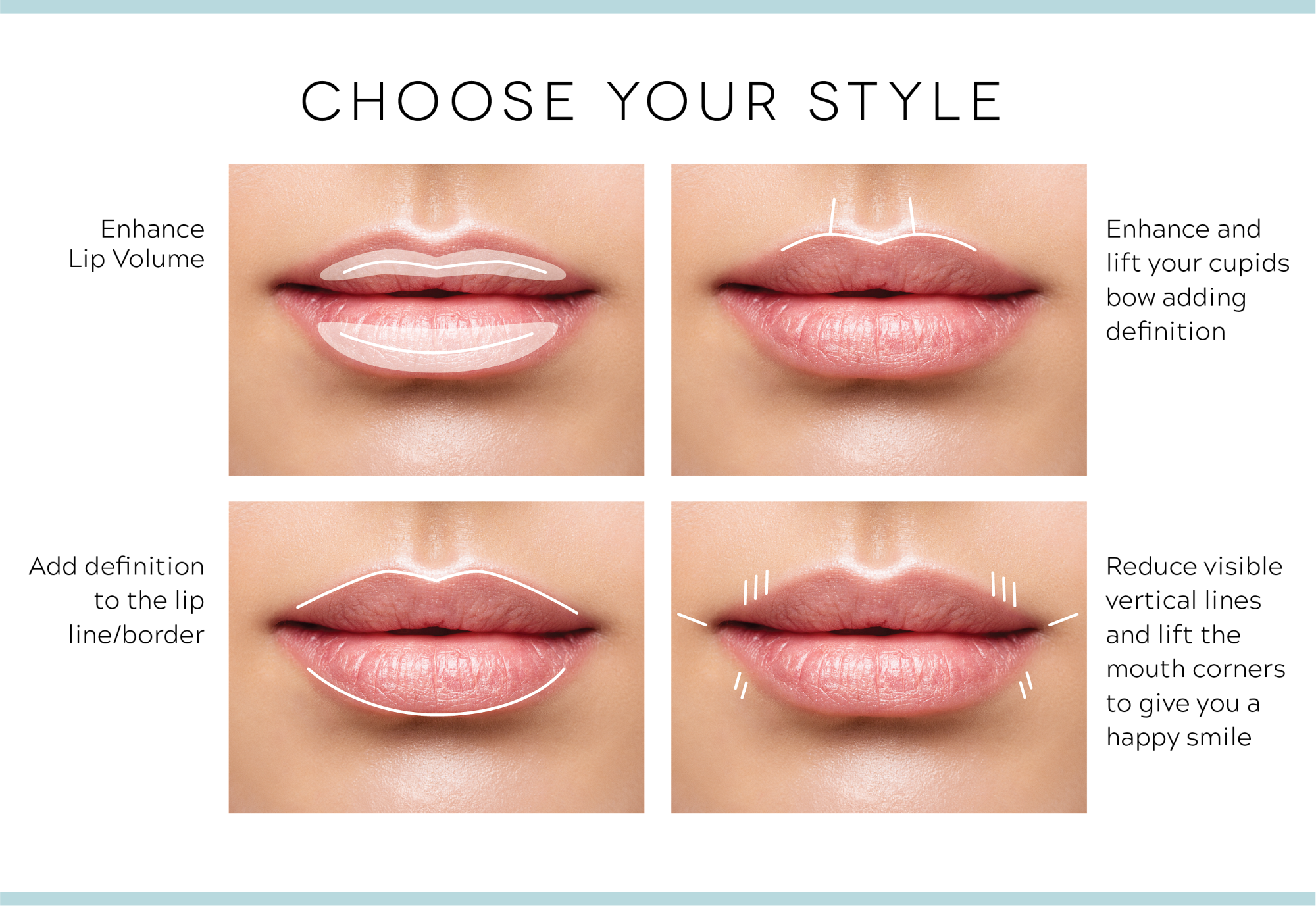Which Injectable Fillers Are Best for M Shaped Lips?
