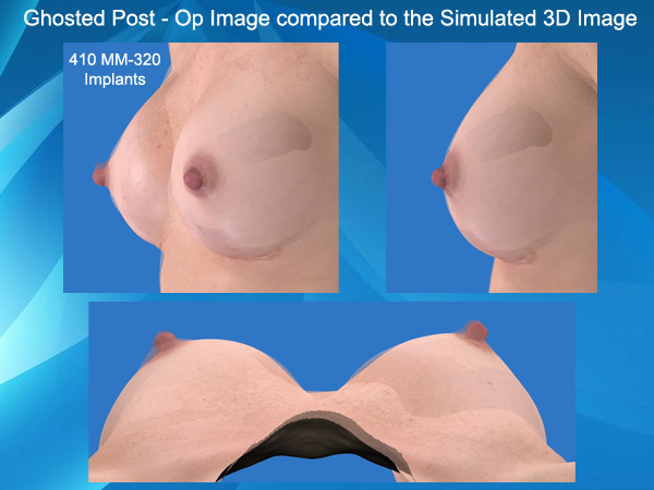 VECTRA® 3D Imaging for Laser Bra Breast Surgery