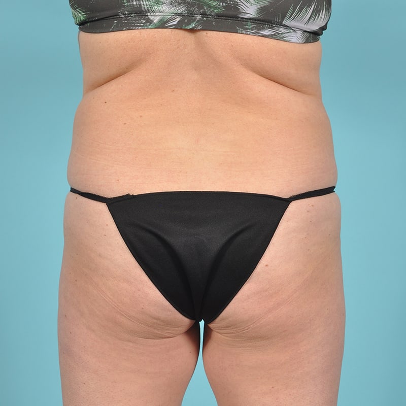 Liposuction Before & After Image Patient 19799