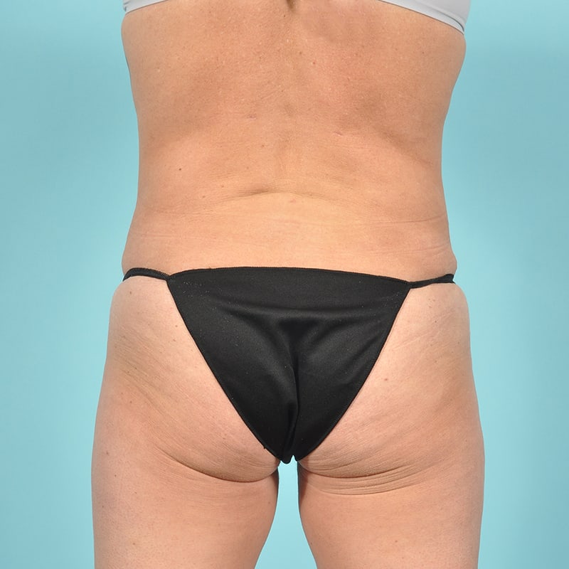 Liposuction Before & After Image Patient 19799