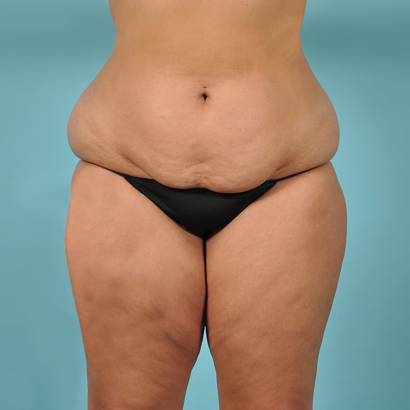 Liposuction Before & After Image Patient 26277