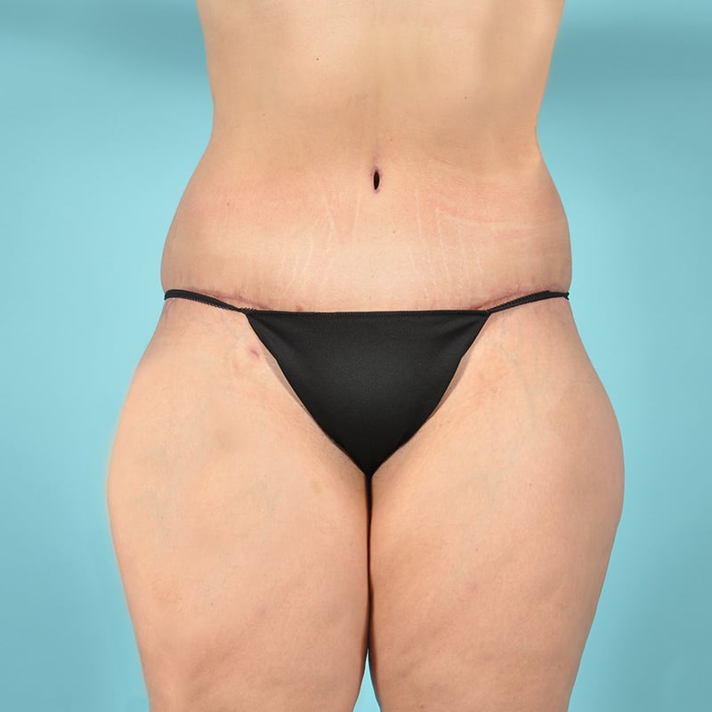 Liposuction Before & After Image