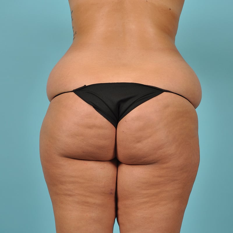 Liposuction Before & After Image Patient 26277