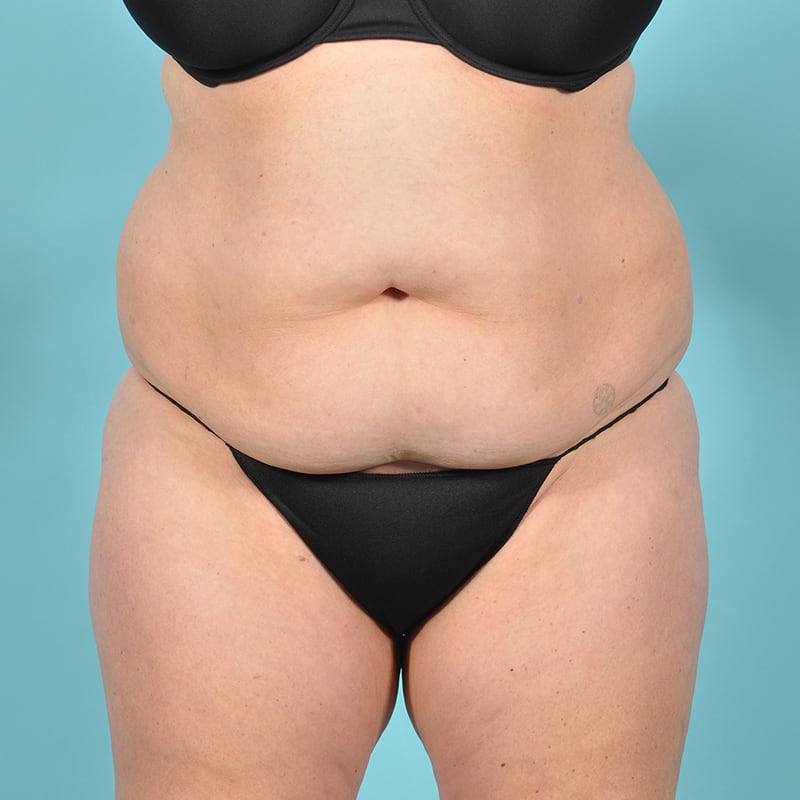 Liposuction Before & After Image Patient 29497