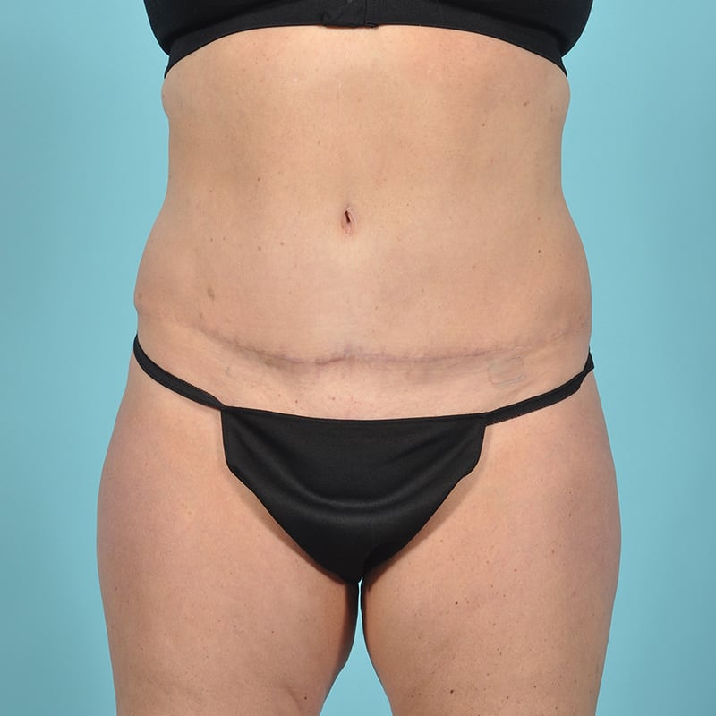 Liposuction Before & After Image