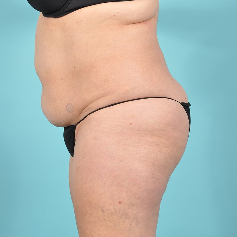 Liposuction Before & After Image