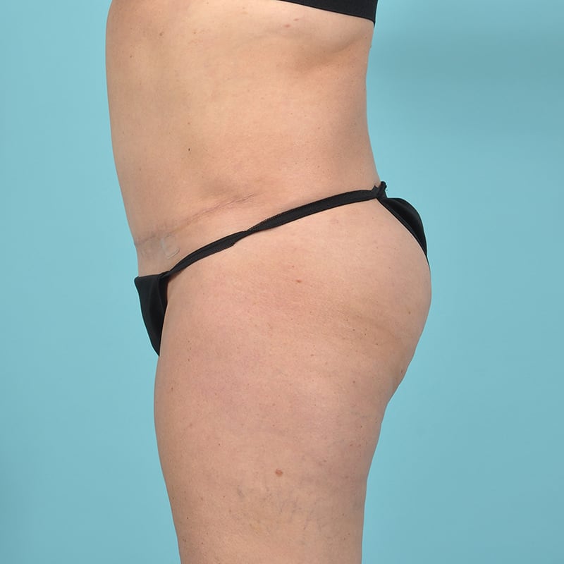 Liposuction Before & After Image Patient 29497