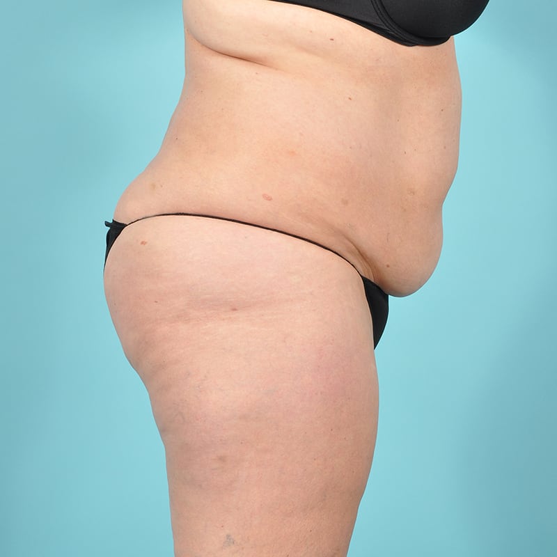 Liposuction Before & After Image Patient 29497