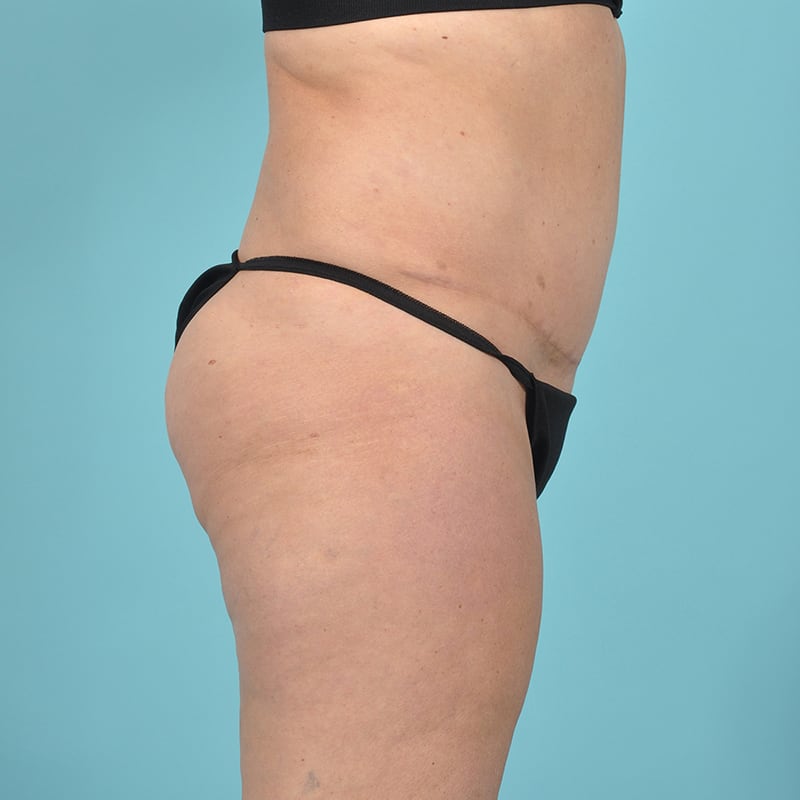 Liposuction Before & After Image Patient 29497