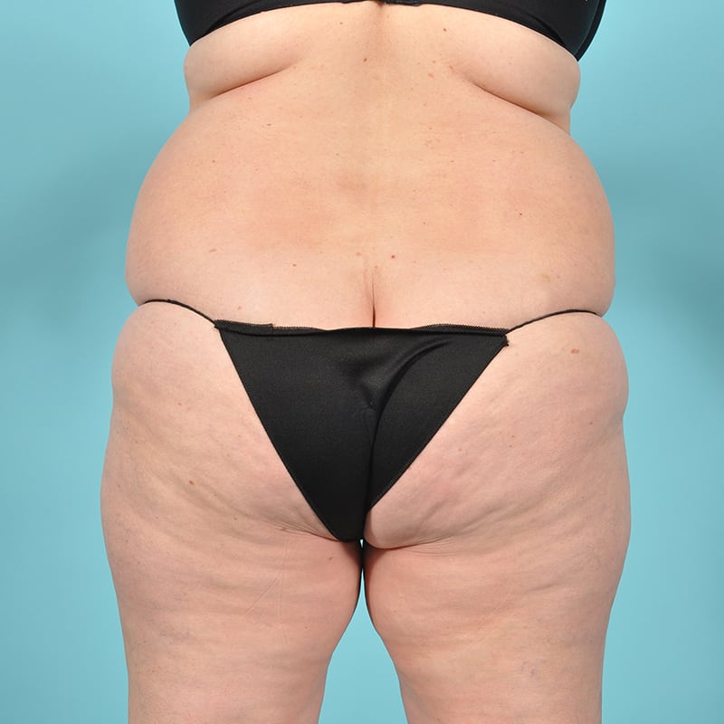 Liposuction Before & After Image Patient 29497