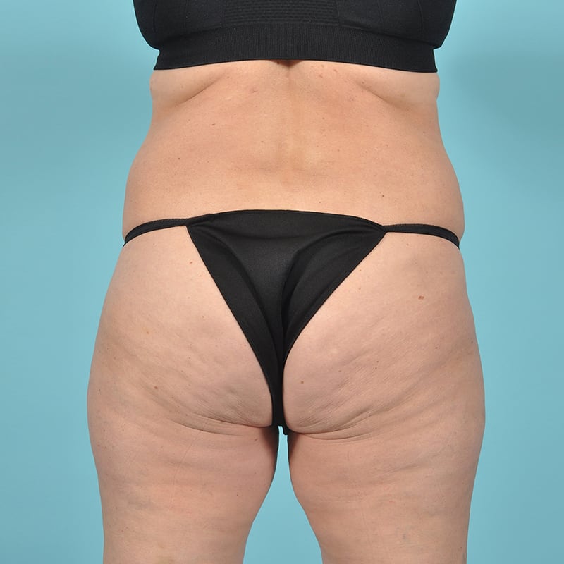 Liposuction Before & After Image Patient 29497