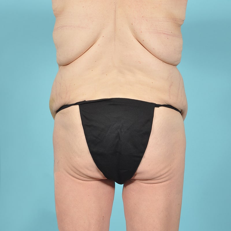 Liposuction Before & After Image Patient 31132