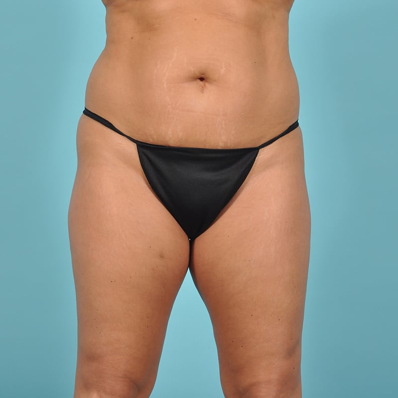 Liposuction Before & After Image