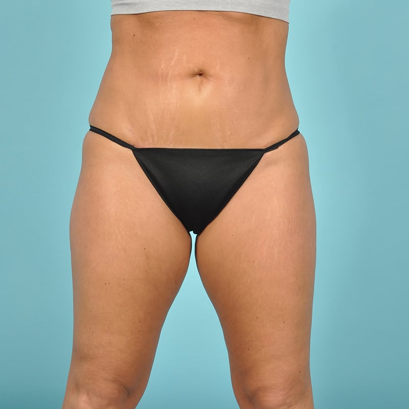 Liposuction Before & After Image Patient 31145