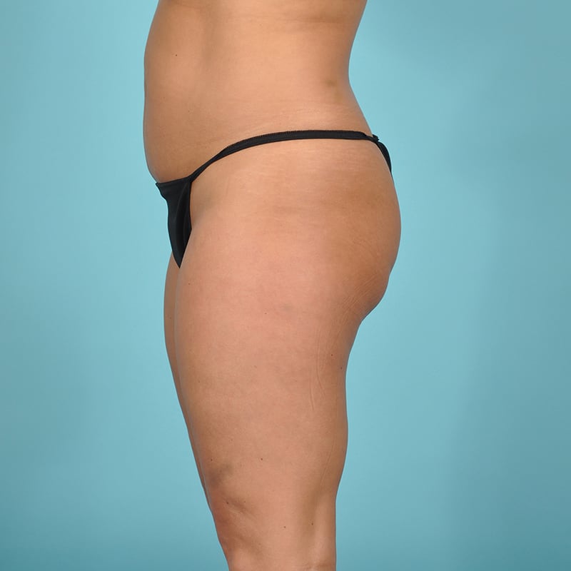 Liposuction Before & After Image