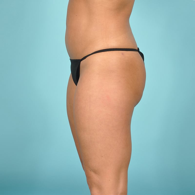 Liposuction Before & After Image Patient 31145