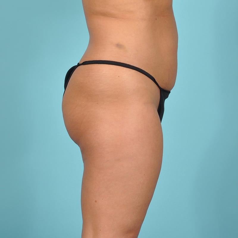 Liposuction Before & After Image