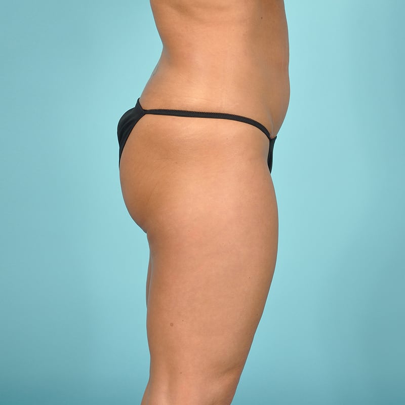 Liposuction Before & After Image