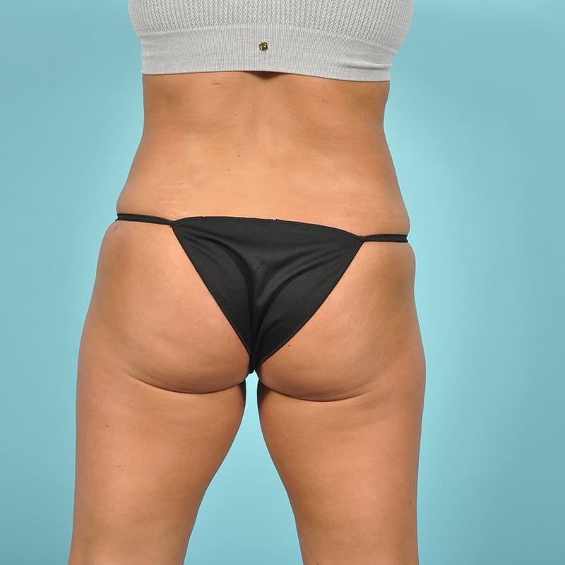 Liposuction Before & After Image Patient 31145