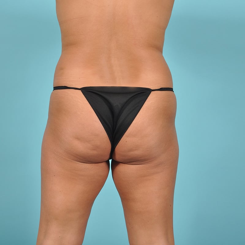 Liposuction Before & After Image Patient 31145