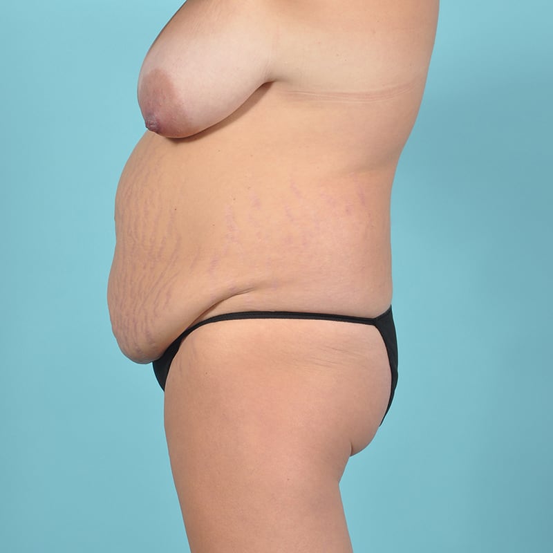 Liposuction Before & After Image