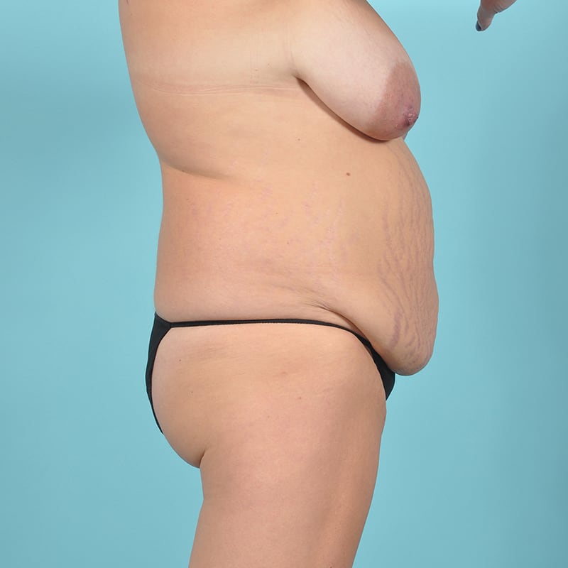 Liposuction Before & After Image Patient 32283