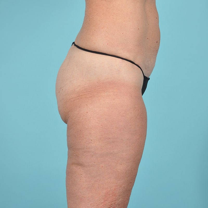 Thigh Lift Before & After Image Patient 33263