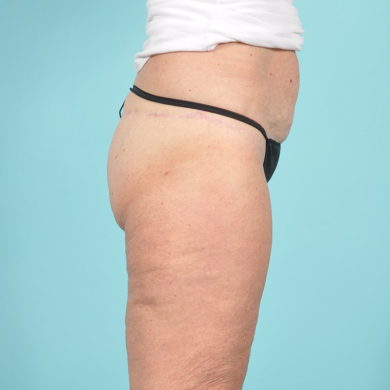 Thigh Lift Before & After Image Patient 33263