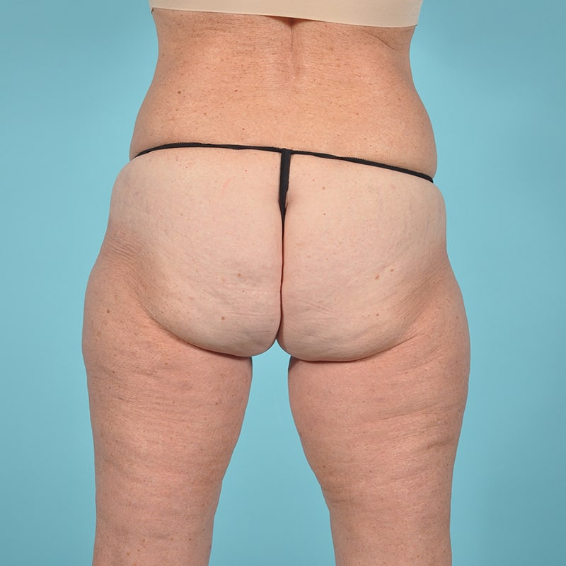 Thigh Lift Before & After Image Patient 33263