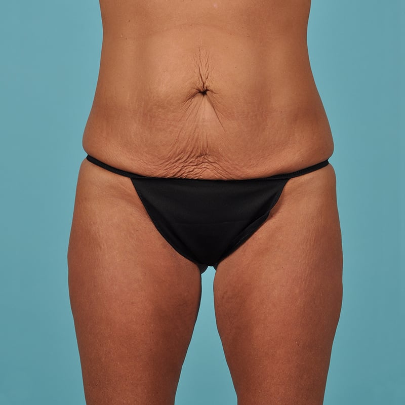 Tummy Tuck Before & After Image