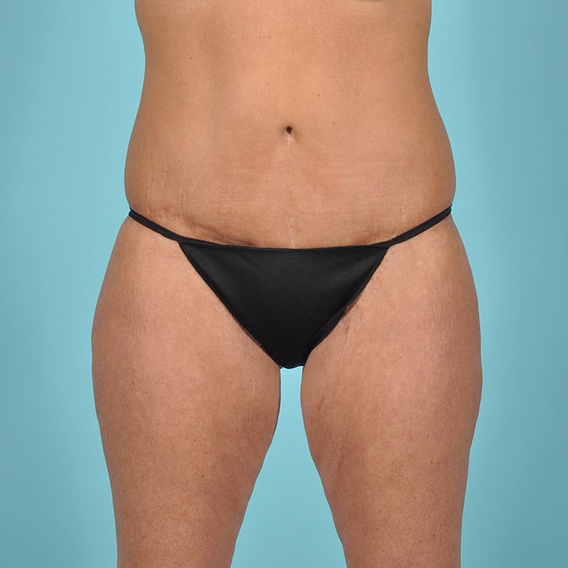 Tummy Tuck Before & After Image