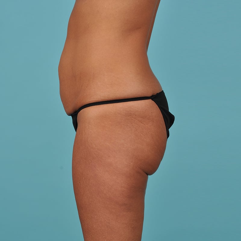 Tummy Tuck Before & After Image