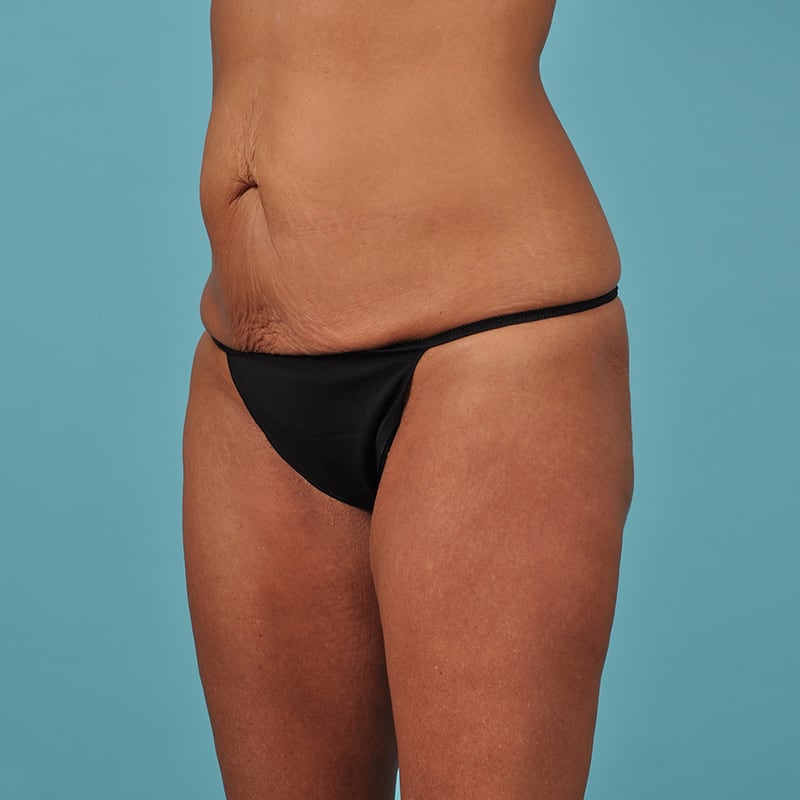 Tummy Tuck Before & After Image