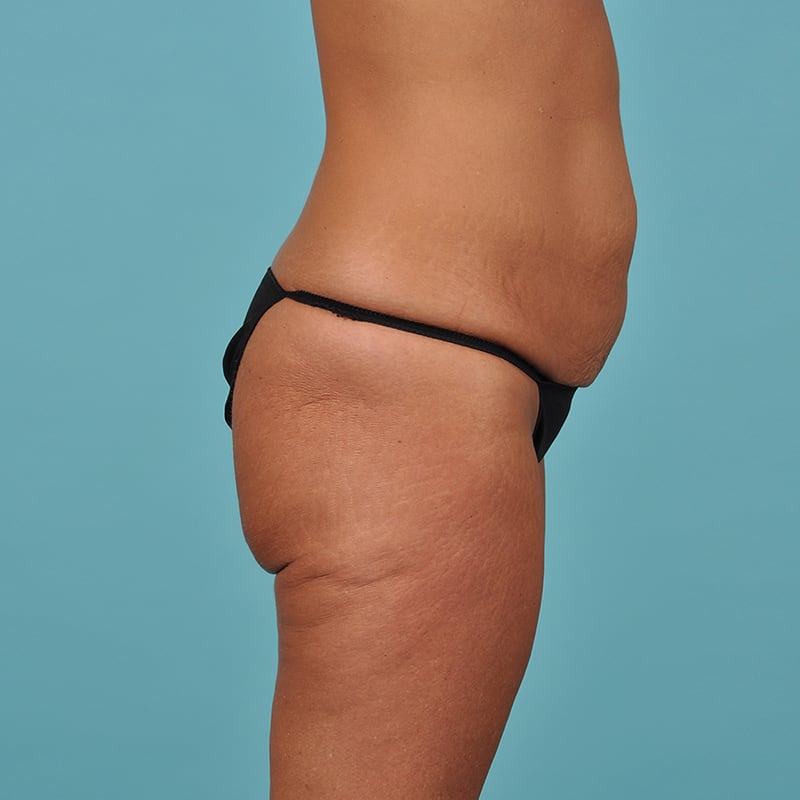 Tummy Tuck Before & After Image Patient 23675