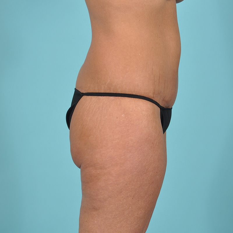 Tummy Tuck Before & After Image Patient 23675