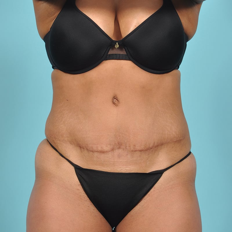 Tummy Tuck Before & After Image