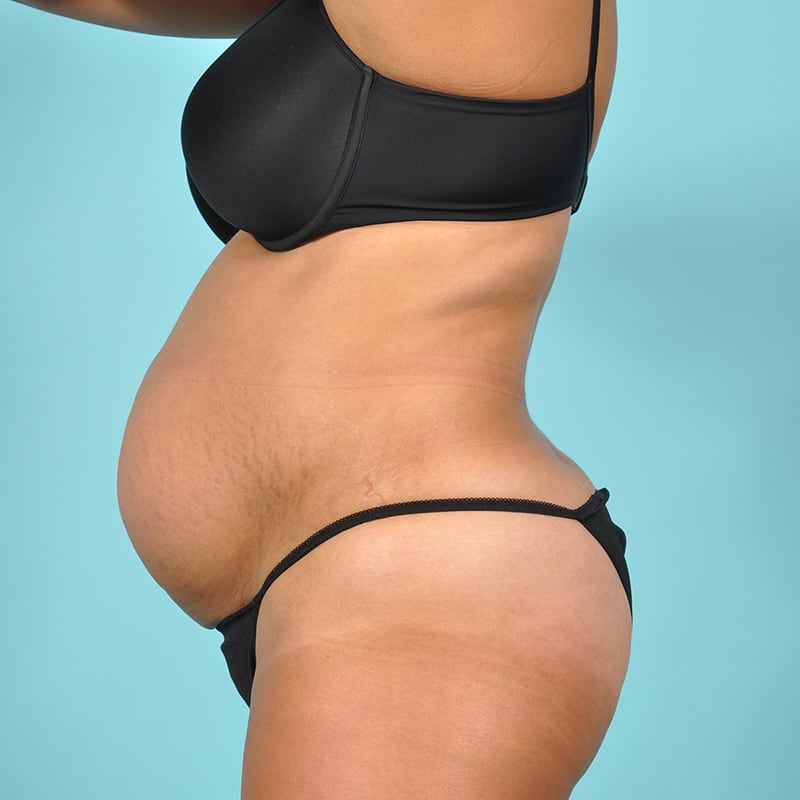 Tummy Tuck Before & After Image Patient 29453