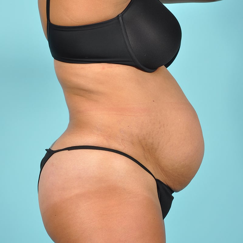 Tummy Tuck Before & After Image