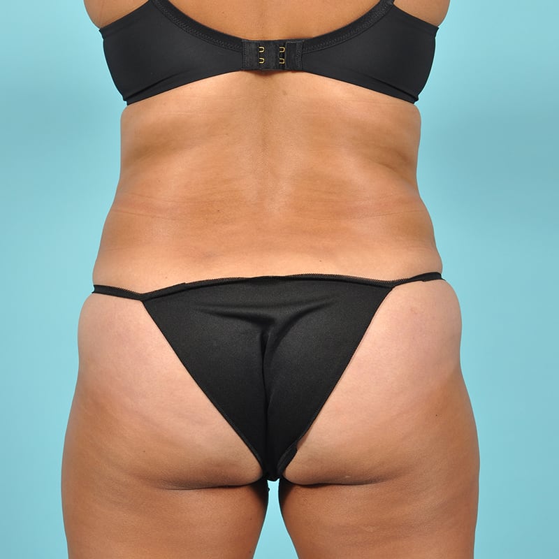 Tummy Tuck Before & After Image Patient 29453