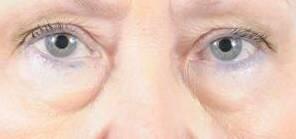 Blepharoplasty Before & After Image Patient 31001
