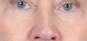 Blepharoplasty Before & After Image Patient 31001
