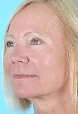 Blepharoplasty Before & After Image Patient 31002