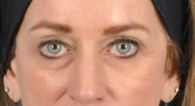 Blepharoplasty Before & After Image Patient 31003