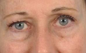 Blepharoplasty Before & After Image Patient 31004