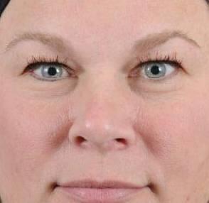 Blepharoplasty Before & After Image Patient 31005